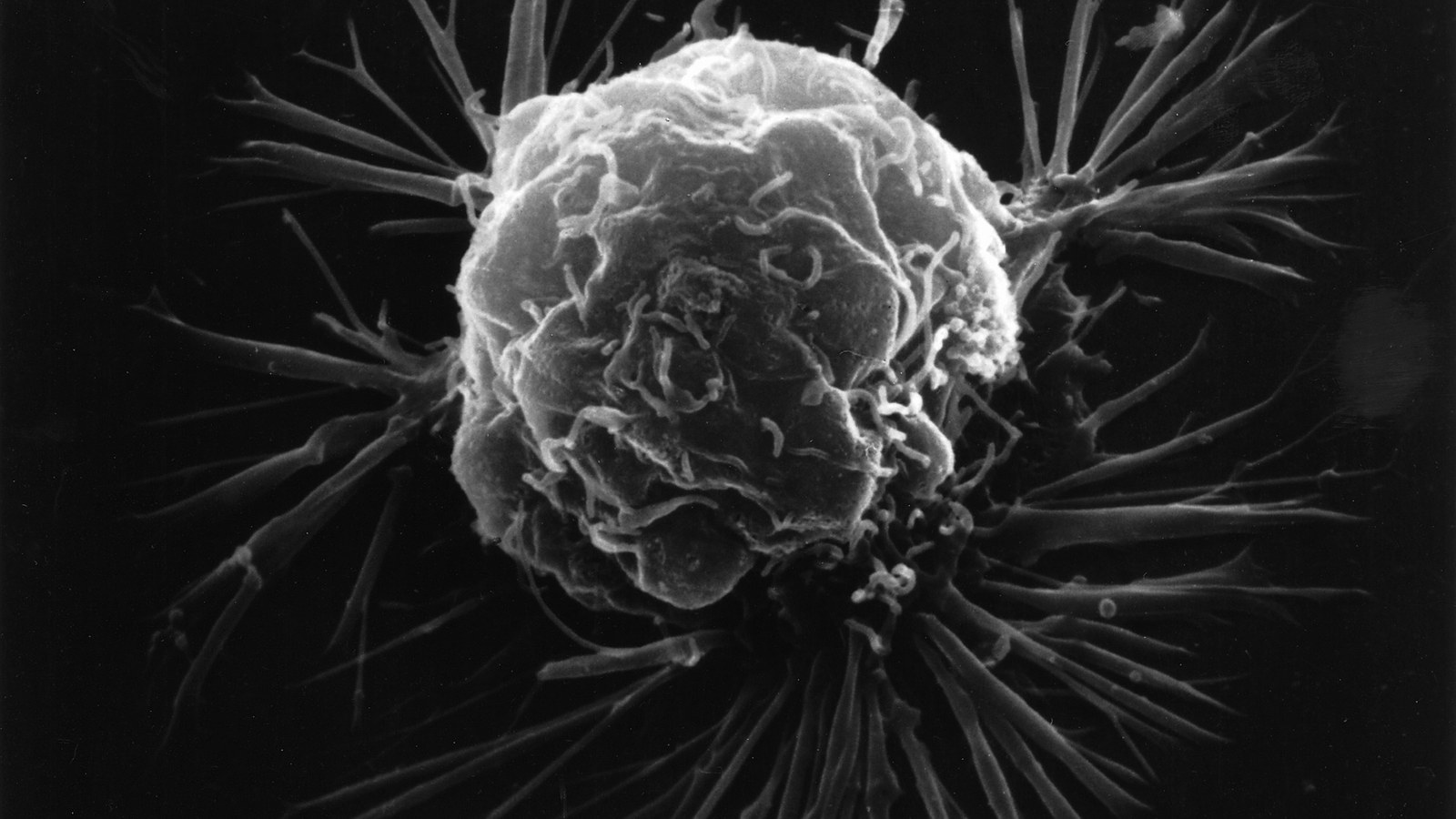 Cercetare clinică privind tratamente pentru cancerul de sân avansat