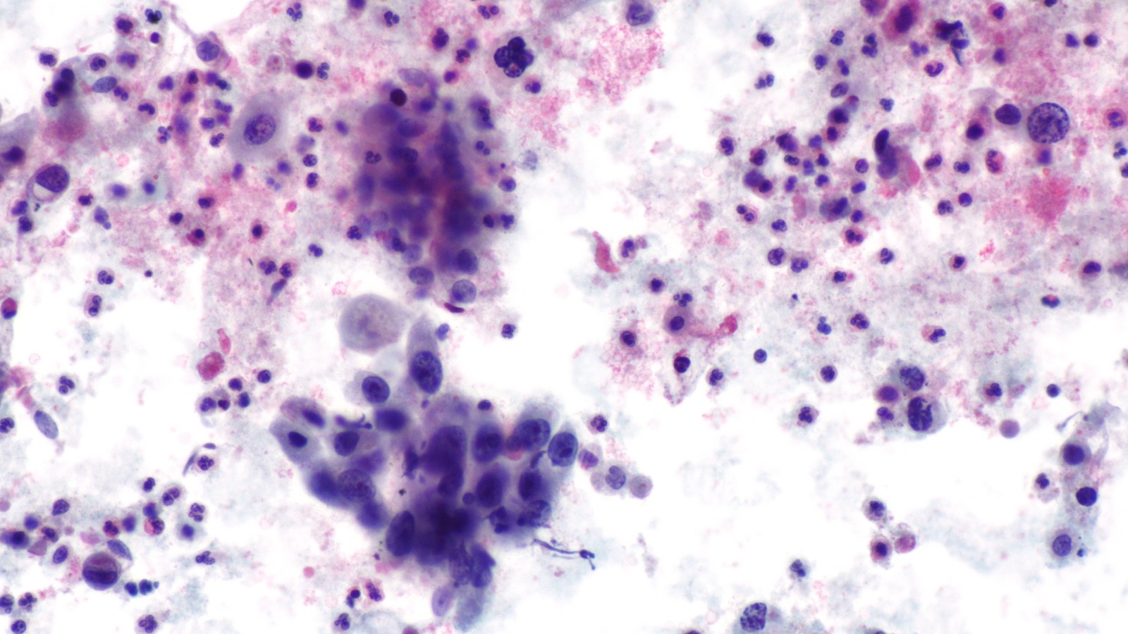 Imagine microscopică a țesutului tumoral pulmonar, utilizată pentru ilustrarea cercetării asupra cancerului pulmonar